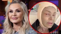 ‘rhoc’-tamra-judge-documents-brow-lift,-face-peel-post-op